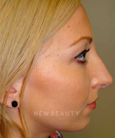 dr-sanjay-grover-rhinoplasty-b