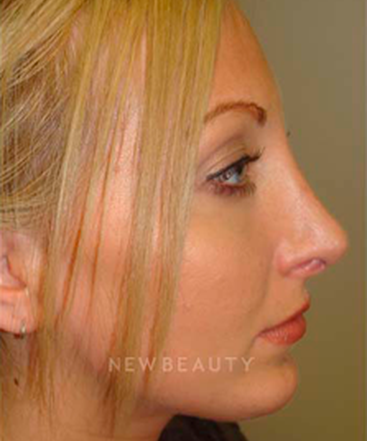 dr-sanjay-grover-rhinoplasty-b