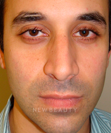 dr-sanjay-grover-rhinoplasty-b