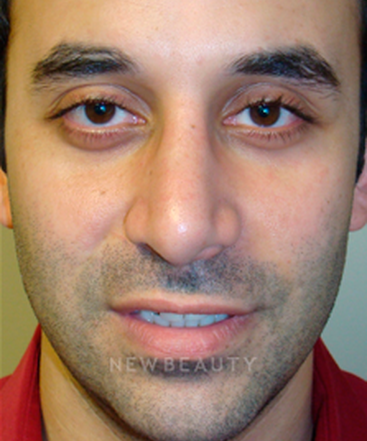 dr-sanjay-grover-rhinoplasty-b