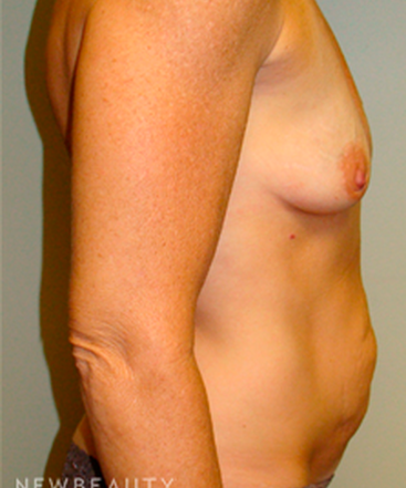 dr-sanjay-grover-breast-augmentation-b