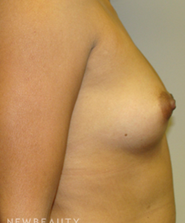 dr-sanjay-grover-breast-augmentation-b