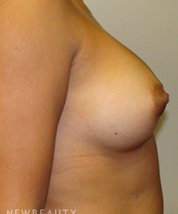 dr-sanjay-grover-breast-augmentation-b