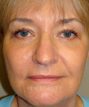 dr-sanjay-grover-blepharoplasty-b