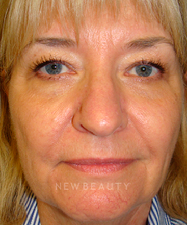 dr-sanjay-grover-blepharoplasty-b