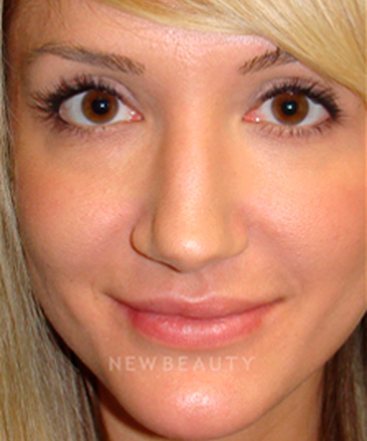 dr-sanjay-grover-rhinoplasty-b