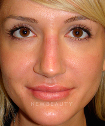 dr-sanjay-grover-rhinoplasty-b