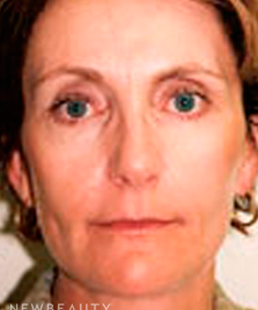 dr-sanjay-grover-facelift-b
