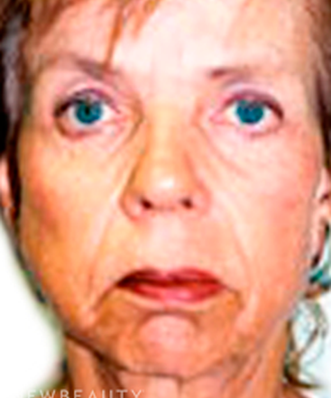 dr-sanjay-grover-facelift-b