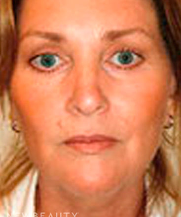 dr-sanjay-grover-facelift-b