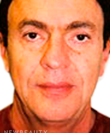 dr-sanjay-grover-facelift-b