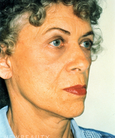 dr-david-rapaport-eyelid-lift-facelift-b