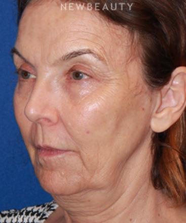 dr-dilip-madnani-facelift-necklift-b