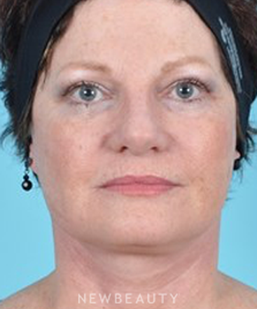 dr-brad-bengtson-facelift-b