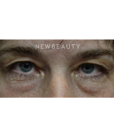 dr-baljeet-k-purewal-blepharoplasties-b