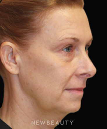 dr-dilip-madnani-facelift-b