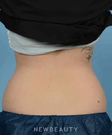 dr-jeffrey-wise-coolsculpting-b