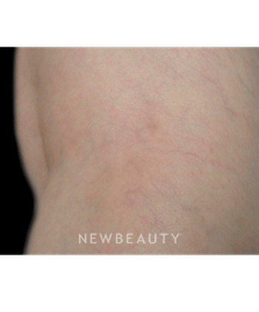 dr-marina-peredo-vein-treatment-b