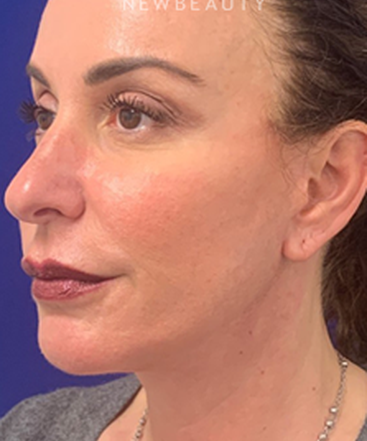 dr-dilip-madnani-facial-rejuvenation-b