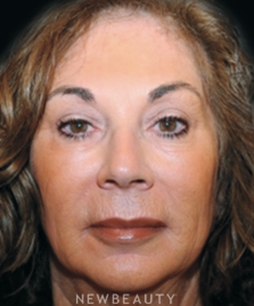 dr-janet-allenby-injectables-fillers-b