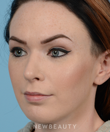 dr-jeffrey-wise-rhinoplasty-b