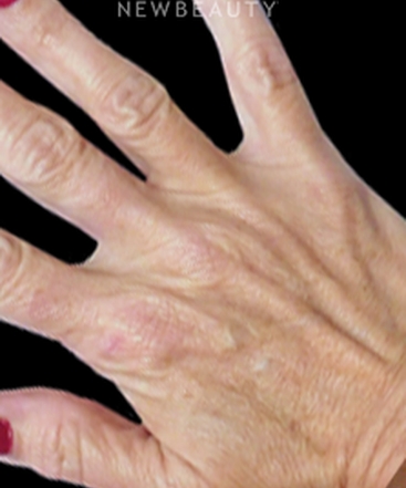 dr-kenneth-r-beer-hand-rejuvenation-b