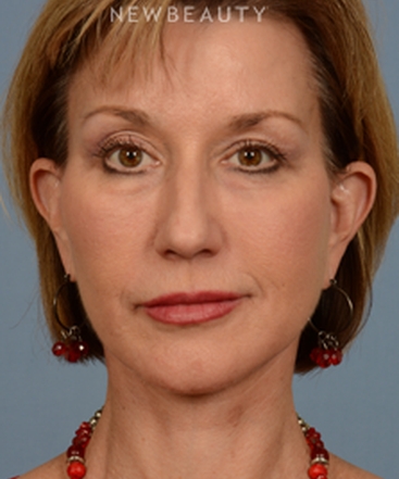 dr-bryan-w-gawley-facial-rejuvenation-b