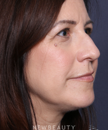 la-jolla-cosmetic-surgery-rhinoplasty-b