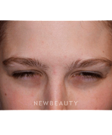 dr-marina-peredo-botox-b