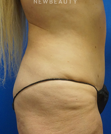 dr-niki-christopoulos-tummy-tuck-b