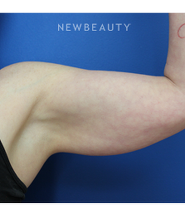 dr-joseph-russo-arm-liposuction-b