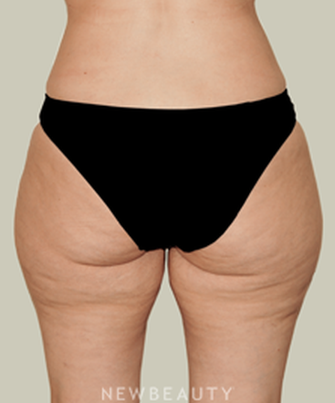 dr-david-rapaport-liposuction-b