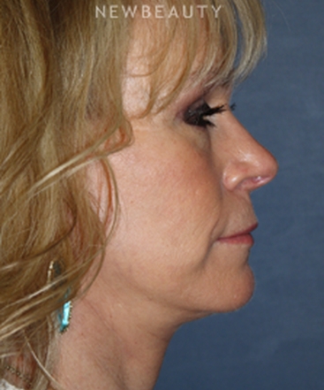 dr-brent-smith-refreshed-results-b