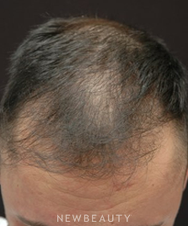 dr-jeffrey-b-wise-hair-transplant-b