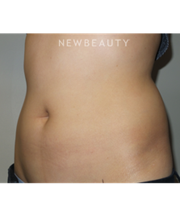 dr-sanjay-grover-coolsculpting-b
