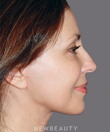 dr-konstantin-vasyukevich-facelift-necklift-b