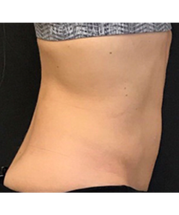 dr-janet-allenby-emsculpt-b