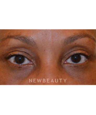 dr-baljeet-purewal-belpharoplasties-b