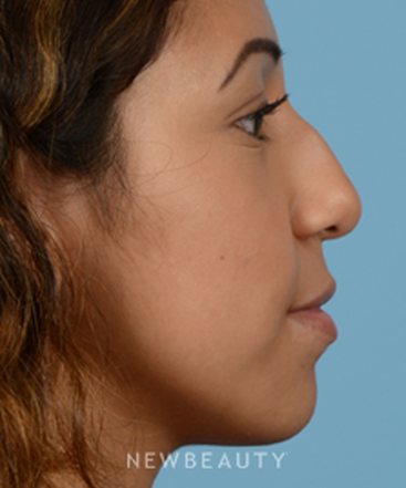 dr-jeffrey-b-wise-rhinoplasty-b