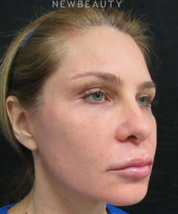 dr-joseph-grzeskiewicz-macs-facelift-b