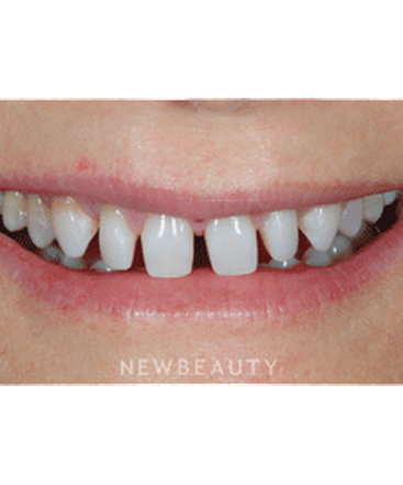 dr-guy-lewis-veneers-gum-lift-b