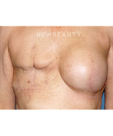 dr-bryan-gawley-breast-reconstruction-b