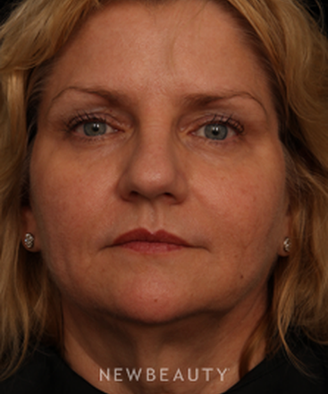 dr-jennifer-m-segal-facial-rejuvenation-b