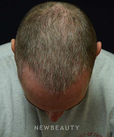 dr-jeffrey-b-wise-hair-loss-b