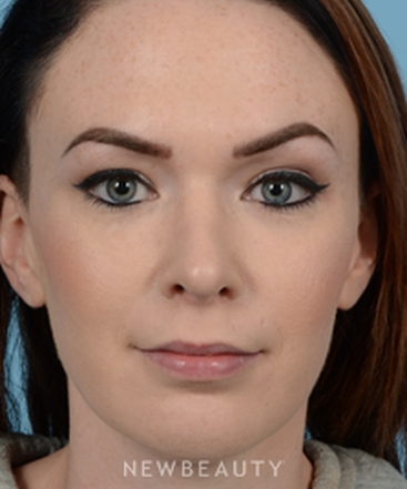 dr-jeffrey-wise-rhinoplasty-b