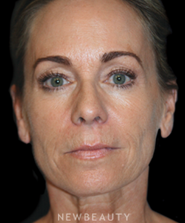dr-brent-smith-mini-facelift-lasers-b