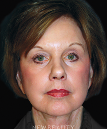 dr-brent-smith-lasers-eye-lift-mini-facelift-b