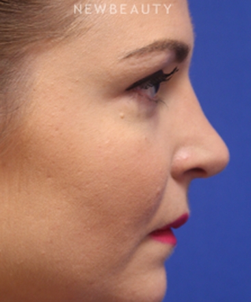 dr-jennifer-m-levine-revision-rhinoplasty-b
