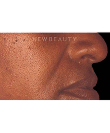 dr-charles-crutchfield-injectable-fillers-b