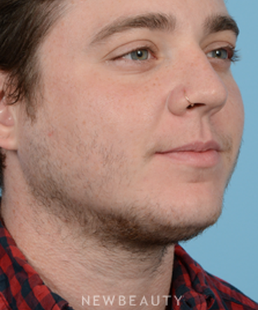 dr-jeffrey-b-wise-hair-transplant-b